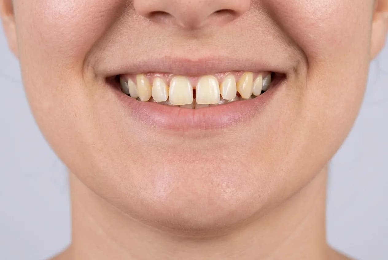 Sorriso antes das facetas: dentes desalinhados, com espaço entre os incisivos